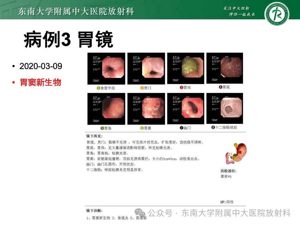 影像PPT - 【病例】胃部/胃周占位随访-18