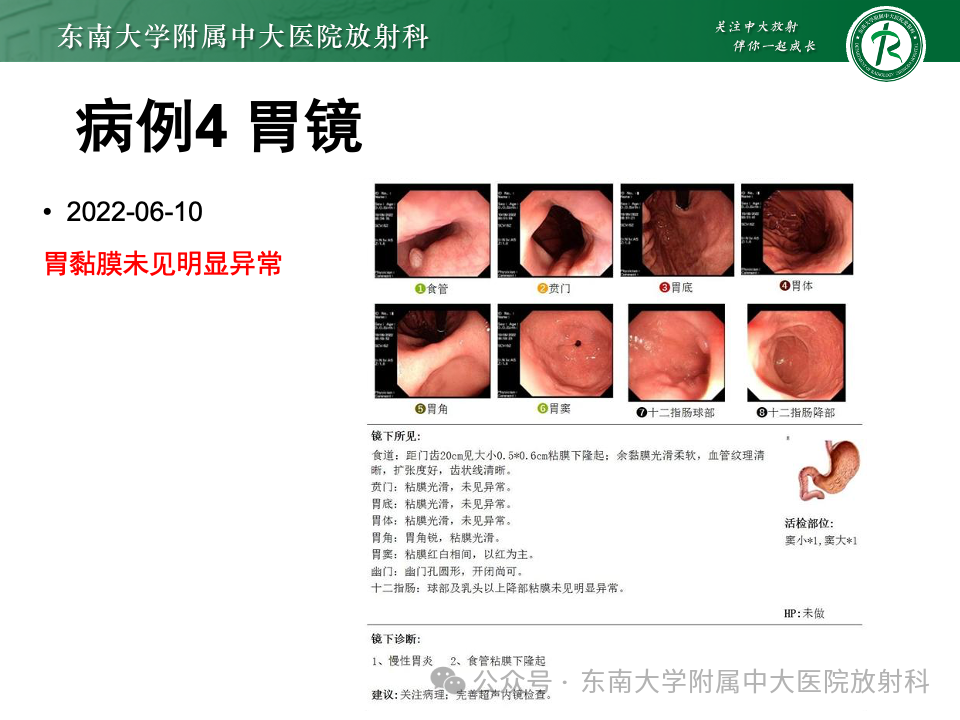 影像PPT - 【病例】胃部/胃周占位随访-26
