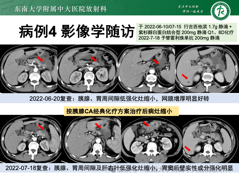 影像PPT - 【病例】胃部/胃周占位随访-27