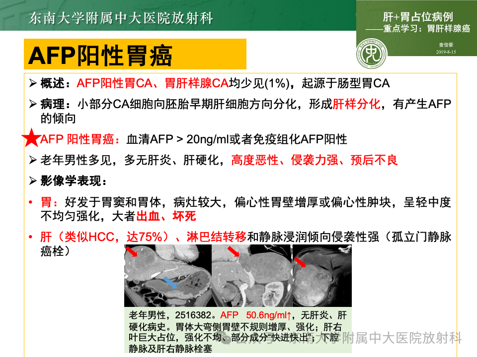 影像PPT - 【病例】胃部/胃周占位随访-43