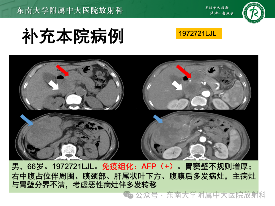 影像PPT - 【病例】胃部/胃周占位随访-44