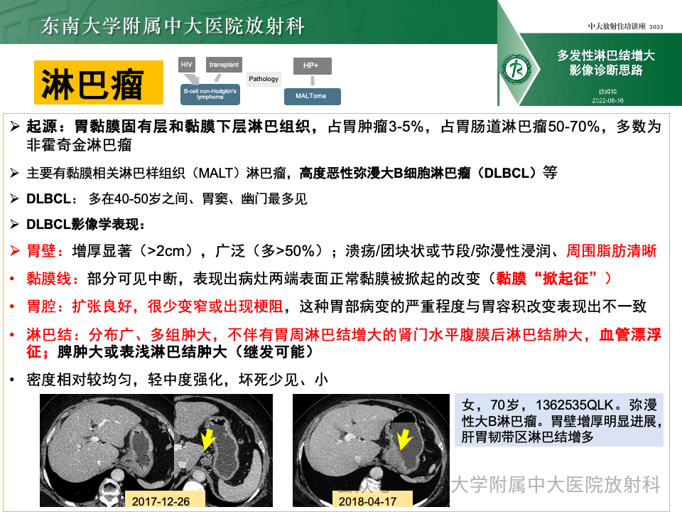 影像PPT - 【病例】胃部/胃周占位随访-46
