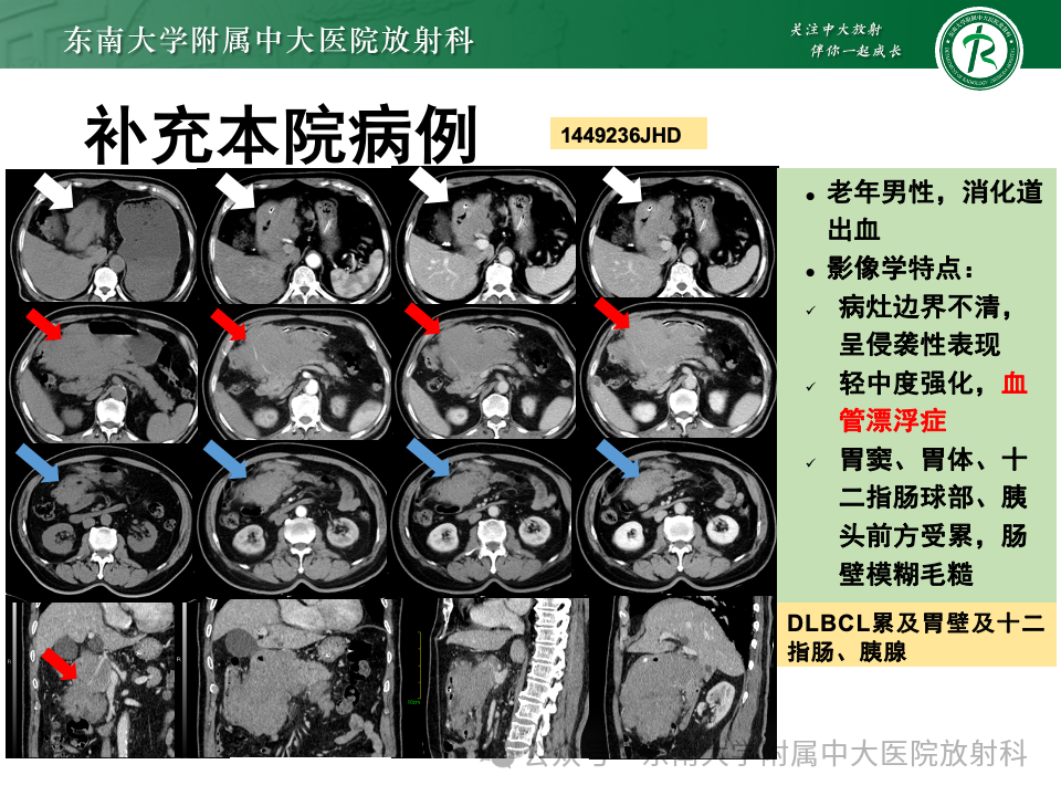 影像PPT - 【病例】胃部/胃周占位随访-47