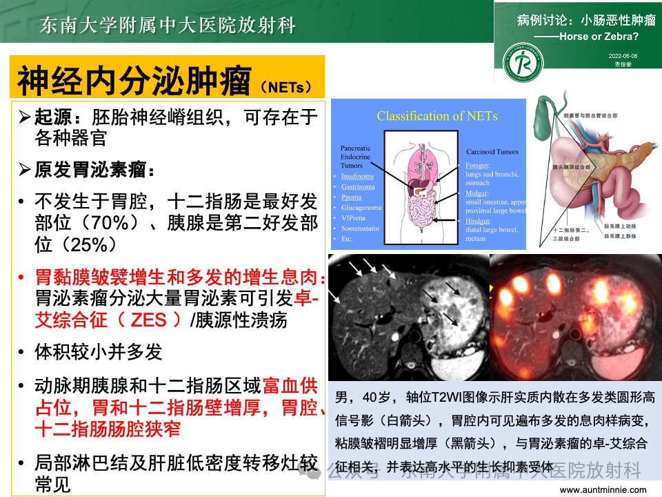 影像PPT - 【病例】胃部/胃周占位随访-52