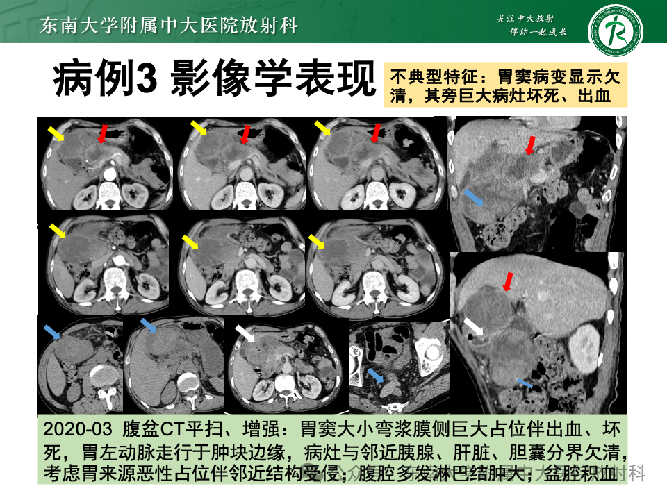 影像PPT - 【病例】胃部/胃周占位随访-1