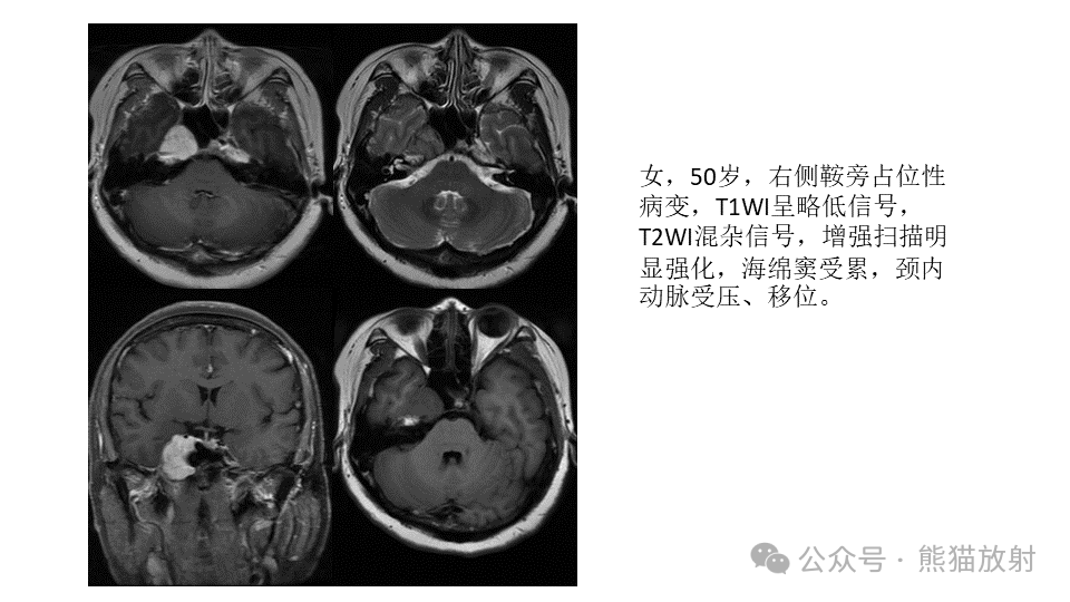 影像PPT - 【病例】鞍旁神经鞘瘤2例CT及MR影像-18
