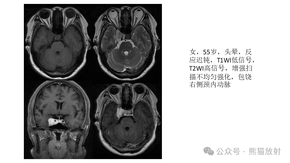 影像PPT - 【病例】鞍旁神经鞘瘤2例CT及MR影像-23