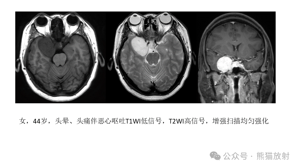 影像PPT - 【病例】鞍旁神经鞘瘤2例CT及MR影像-24
