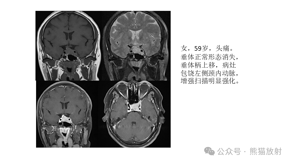 影像PPT - 【病例】鞍旁神经鞘瘤2例CT及MR影像-33