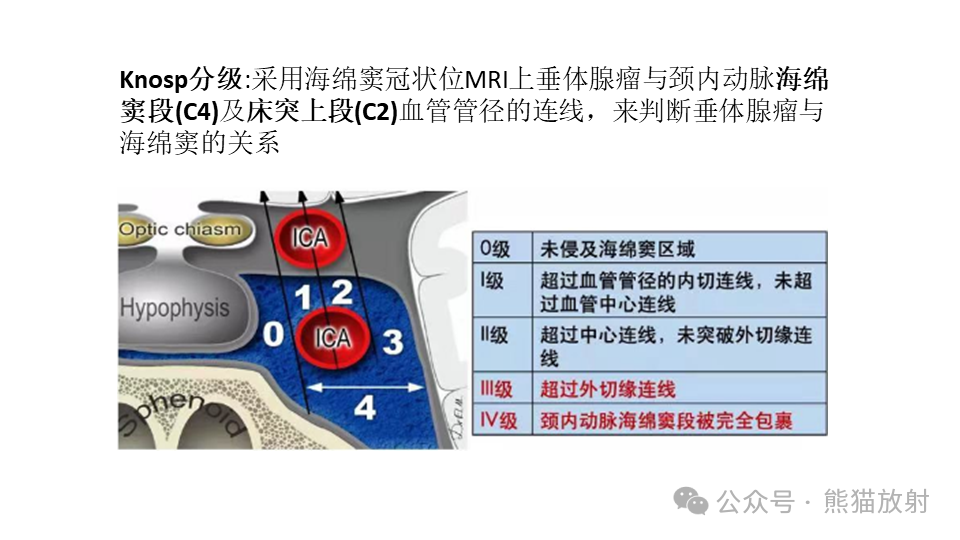 影像PPT - 【病例】鞍旁神经鞘瘤2例CT及MR影像-32
