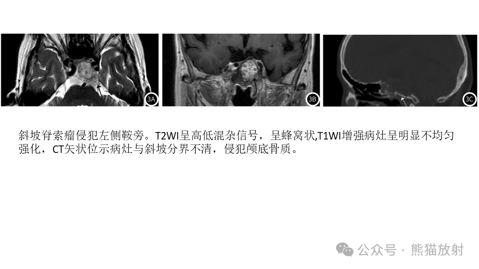 影像PPT - 【病例】鞍旁神经鞘瘤2例CT及MR影像-36