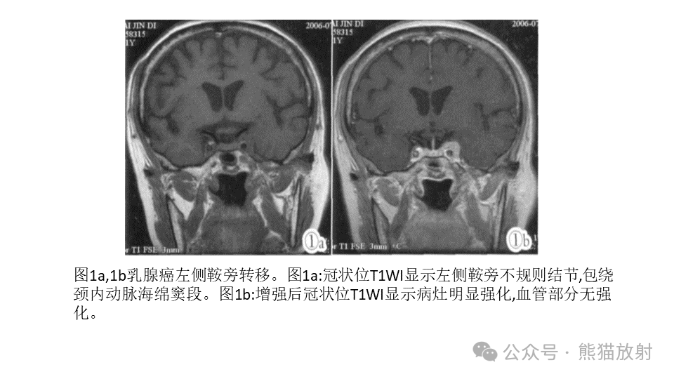 影像PPT - 【病例】鞍旁神经鞘瘤2例CT及MR影像-40