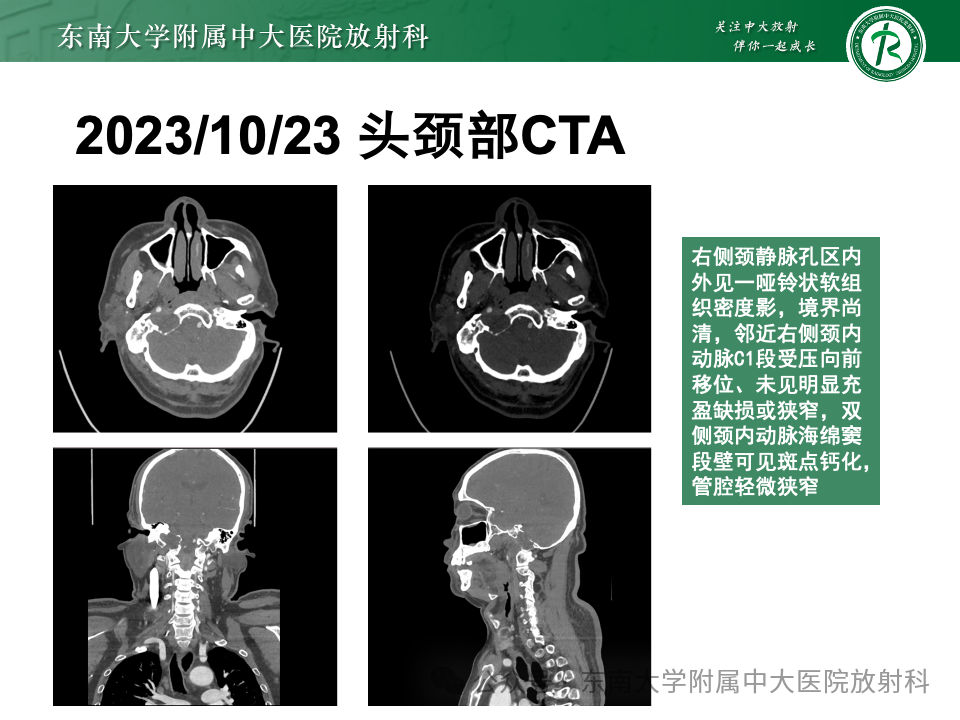 影像PPT - 【PPT】颈静脉孔区肿瘤-4 影像PPT - 【PPT】颈静脉孔区肿瘤-4