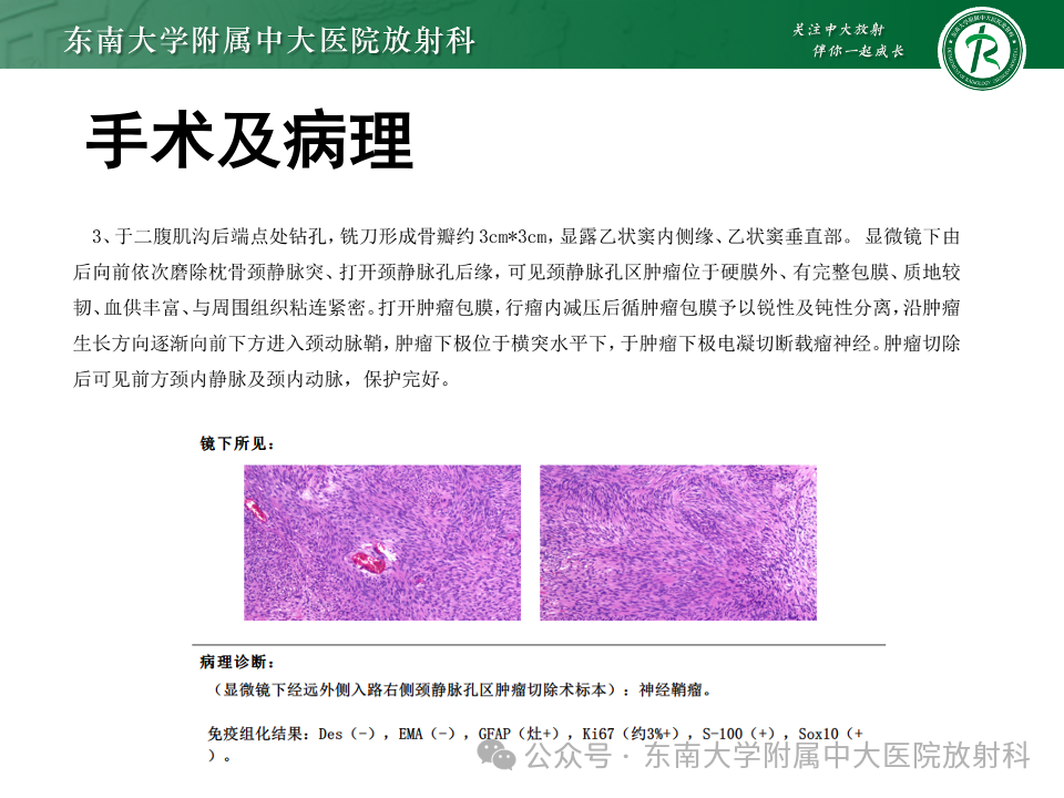 影像PPT - 【PPT】颈静脉孔区肿瘤-6 影像PPT - 【PPT】颈静脉孔区肿瘤-6
