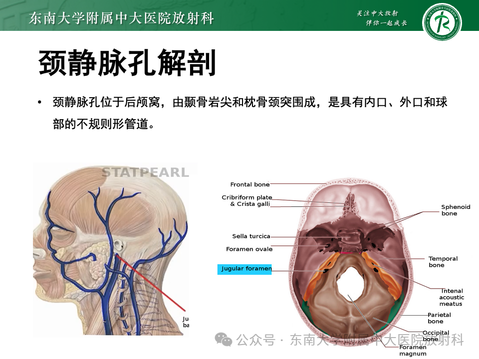 影像PPT - 【PPT】颈静脉孔区肿瘤-8 影像PPT - 【PPT】颈静脉孔区肿瘤-8