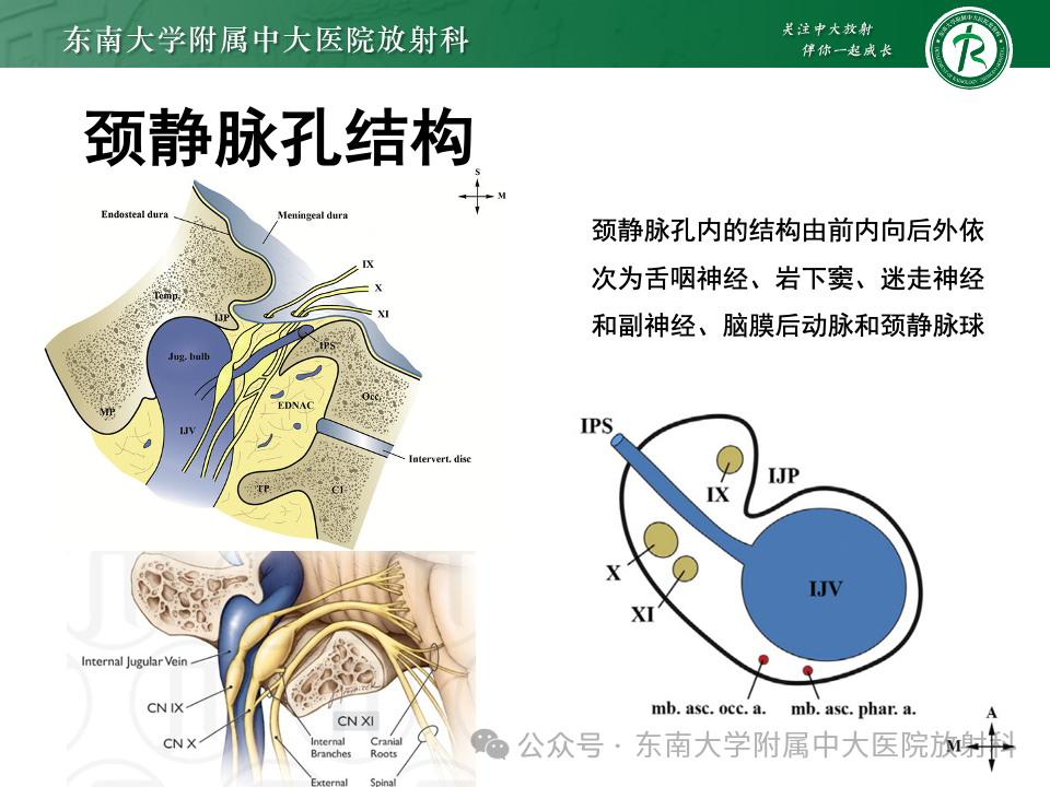 影像PPT - 【PPT】颈静脉孔区肿瘤-9 影像PPT - 【PPT】颈静脉孔区肿瘤-9
