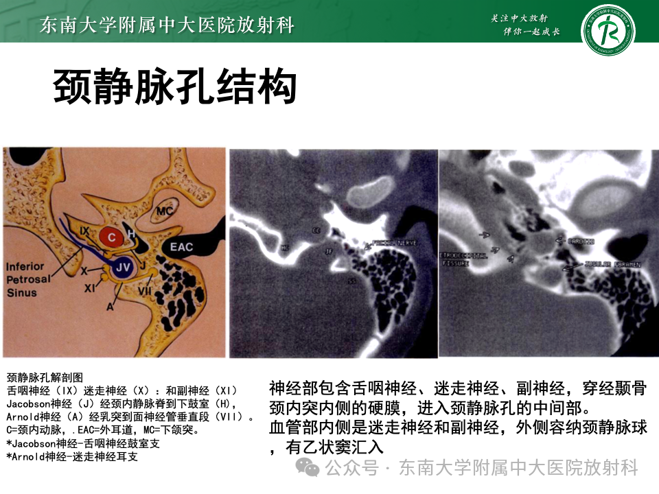 影像PPT - 【PPT】颈静脉孔区肿瘤-10 影像PPT - 【PPT】颈静脉孔区肿瘤-10