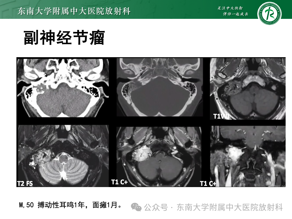 影像PPT - 【PPT】颈静脉孔区肿瘤-15 影像PPT - 【PPT】颈静脉孔区肿瘤-15