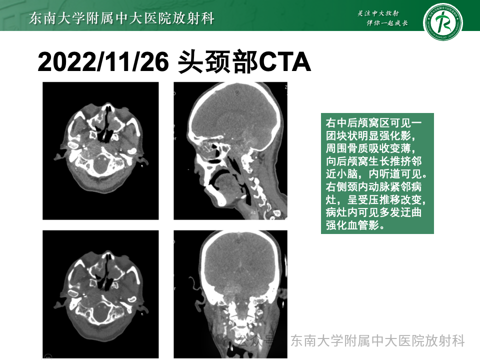 影像PPT - 【PPT】颈静脉孔区肿瘤-17 影像PPT - 【PPT】颈静脉孔区肿瘤-17
