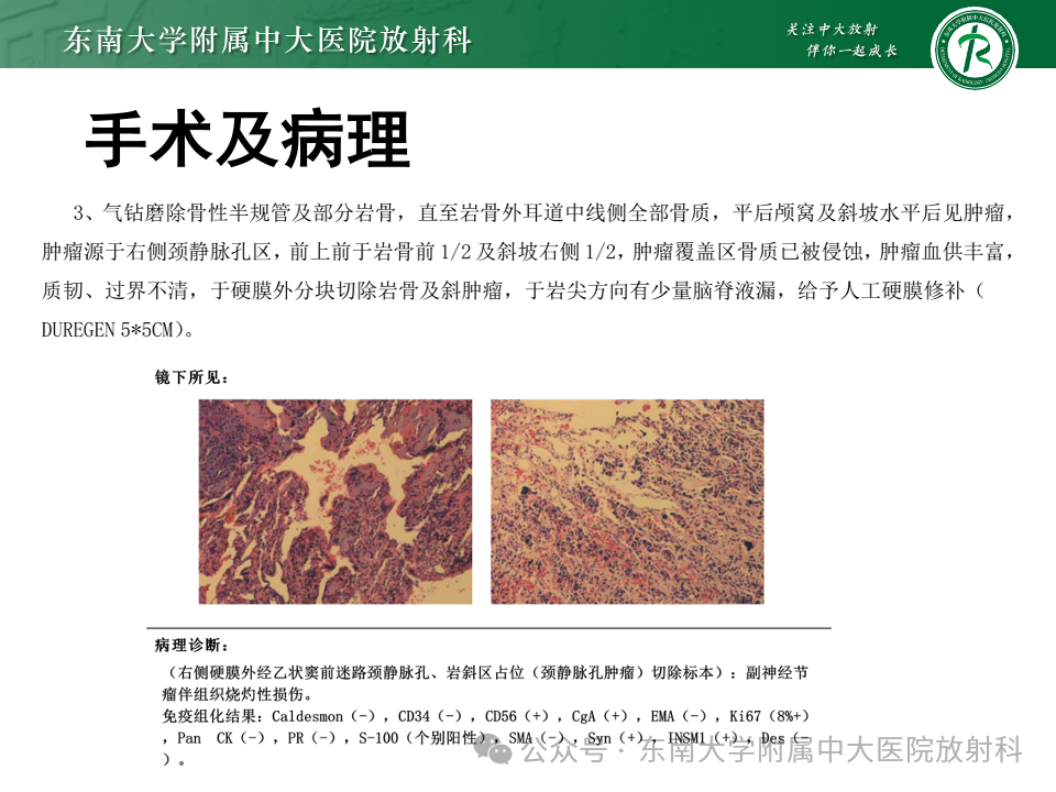 影像PPT - 【PPT】颈静脉孔区肿瘤-18 影像PPT - 【PPT】颈静脉孔区肿瘤-18