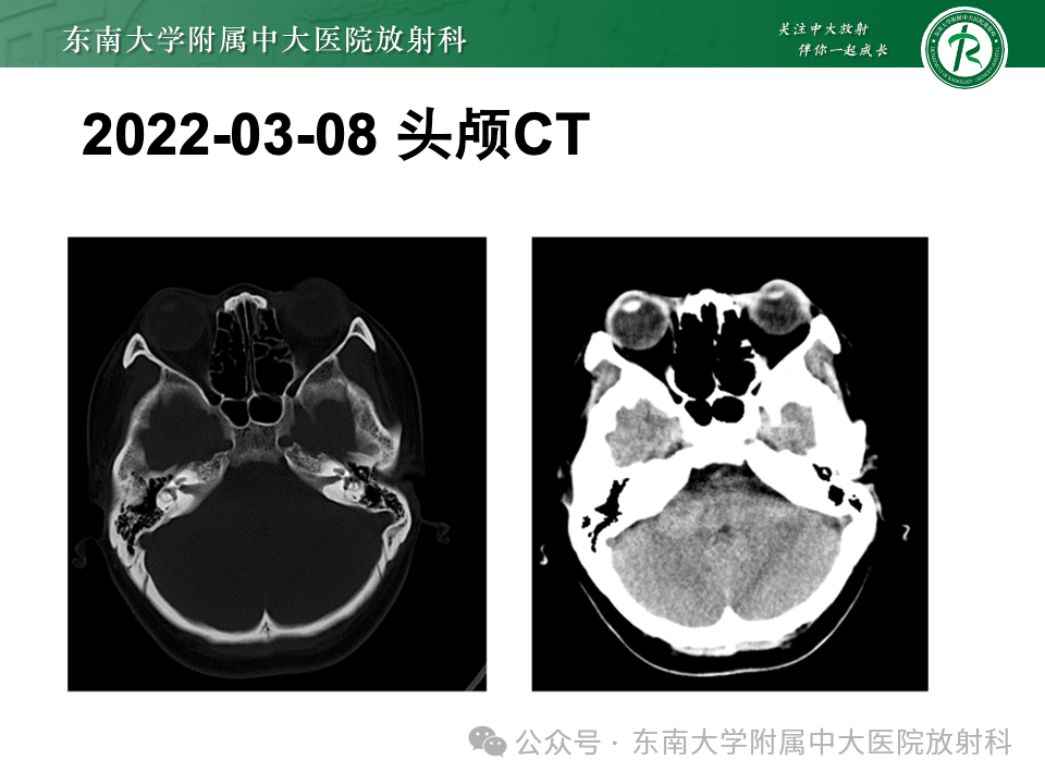影像PPT - 【PPT】颈静脉孔区肿瘤-22 影像PPT - 【PPT】颈静脉孔区肿瘤-22