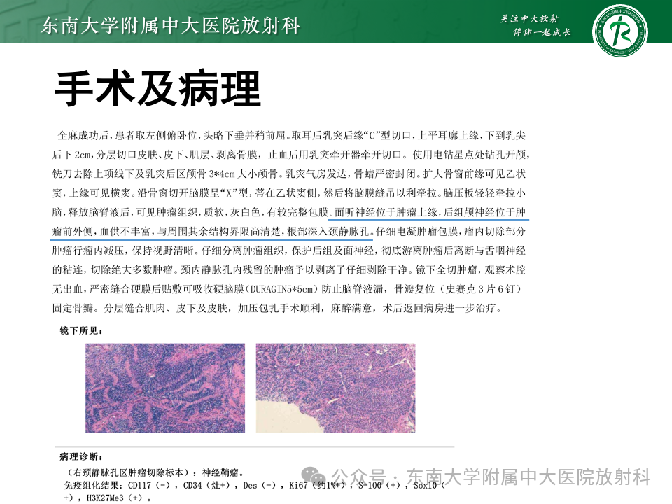 影像PPT - 【PPT】颈静脉孔区肿瘤-24 影像PPT - 【PPT】颈静脉孔区肿瘤-24