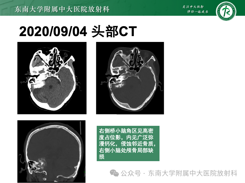 影像PPT - 【PPT】颈静脉孔区肿瘤-29 影像PPT - 【PPT】颈静脉孔区肿瘤-29