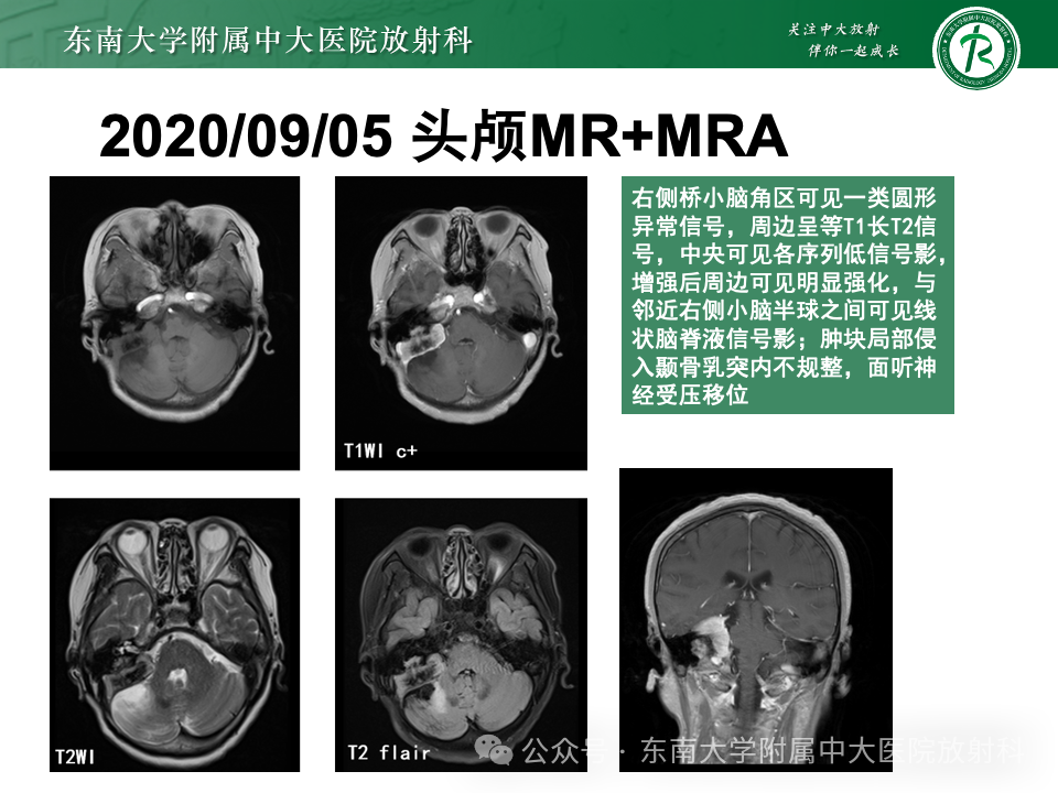 影像PPT - 【PPT】颈静脉孔区肿瘤-30 影像PPT - 【PPT】颈静脉孔区肿瘤-30