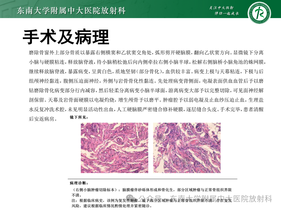 影像PPT - 【PPT】颈静脉孔区肿瘤-31 影像PPT - 【PPT】颈静脉孔区肿瘤-31