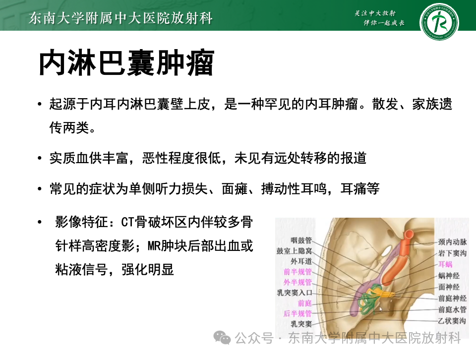 影像PPT - 【PPT】颈静脉孔区肿瘤-32 影像PPT - 【PPT】颈静脉孔区肿瘤-32