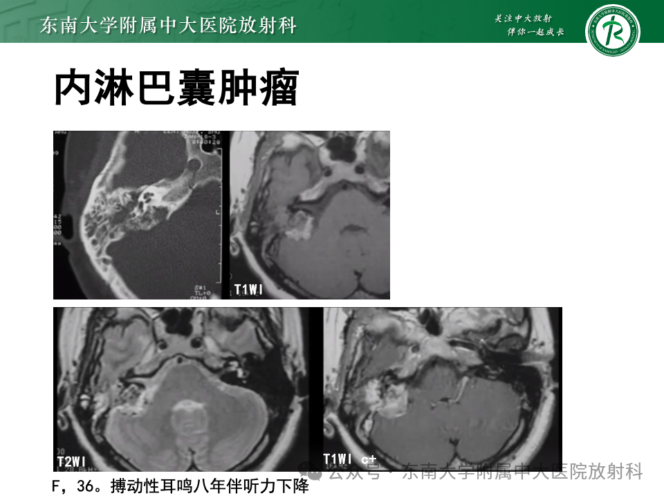 影像PPT - 【PPT】颈静脉孔区肿瘤-33 影像PPT - 【PPT】颈静脉孔区肿瘤-33