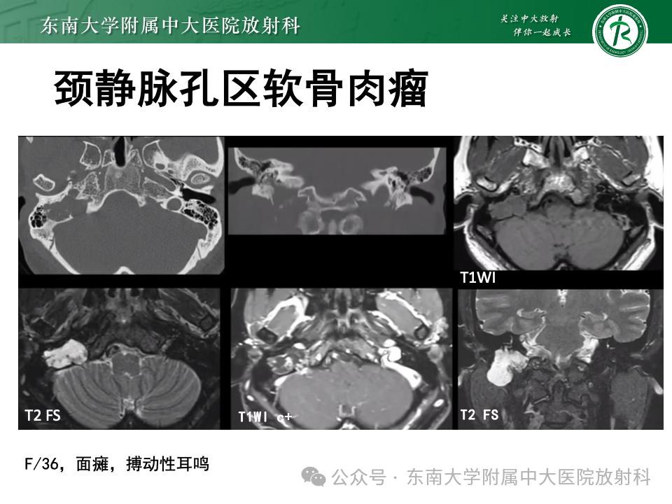 影像PPT - 【PPT】颈静脉孔区肿瘤-35 影像PPT - 【PPT】颈静脉孔区肿瘤-35
