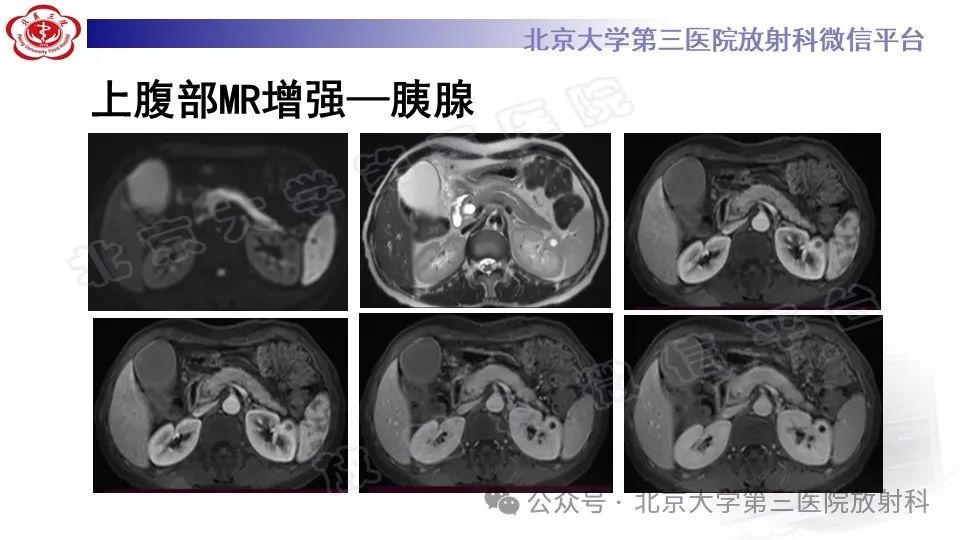 影像PPT - 【PPT】自身免疫性胰腺炎-4