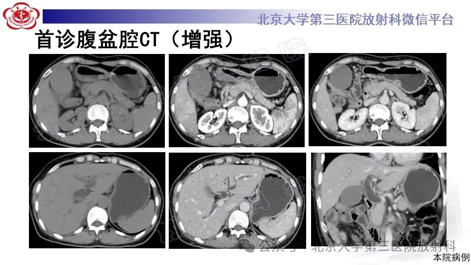 影像PPT - 【PPT】自身免疫性胰腺炎-3