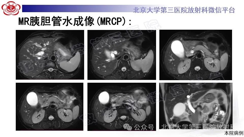 影像PPT - 【PPT】自身免疫性胰腺炎-5