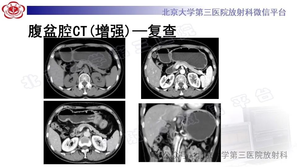 影像PPT - 【PPT】自身免疫性胰腺炎-10