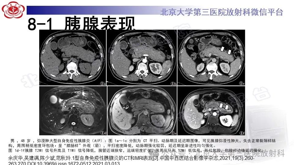 影像PPT - 【PPT】自身免疫性胰腺炎-23