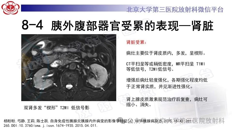 影像PPT - 【PPT】自身免疫性胰腺炎-26