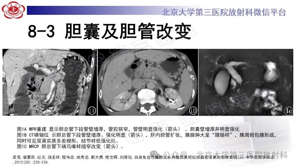 影像PPT - 【PPT】自身免疫性胰腺炎-25