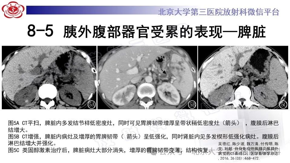 影像PPT - 【PPT】自身免疫性胰腺炎-27