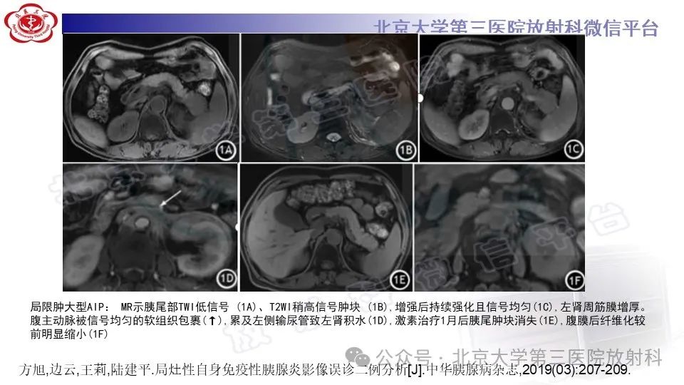 影像PPT - 【PPT】自身免疫性胰腺炎-32