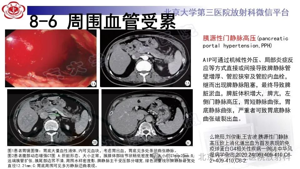 影像PPT - 【PPT】自身免疫性胰腺炎-29
