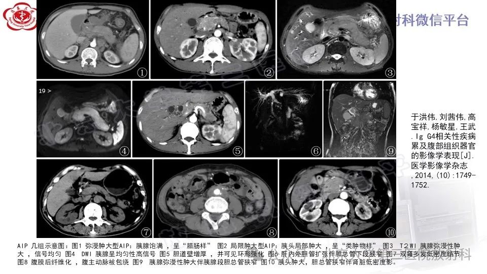 影像PPT - 【PPT】自身免疫性胰腺炎-31
