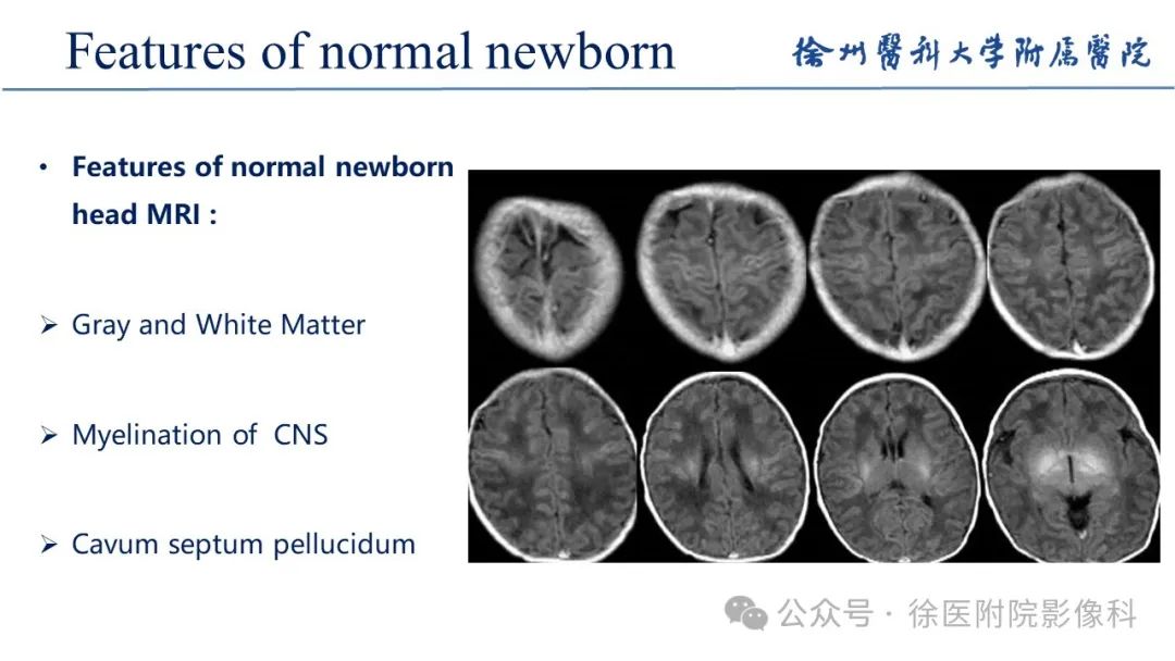 影像PPT - 【PPT】新生儿缺氧缺血性脑病-3