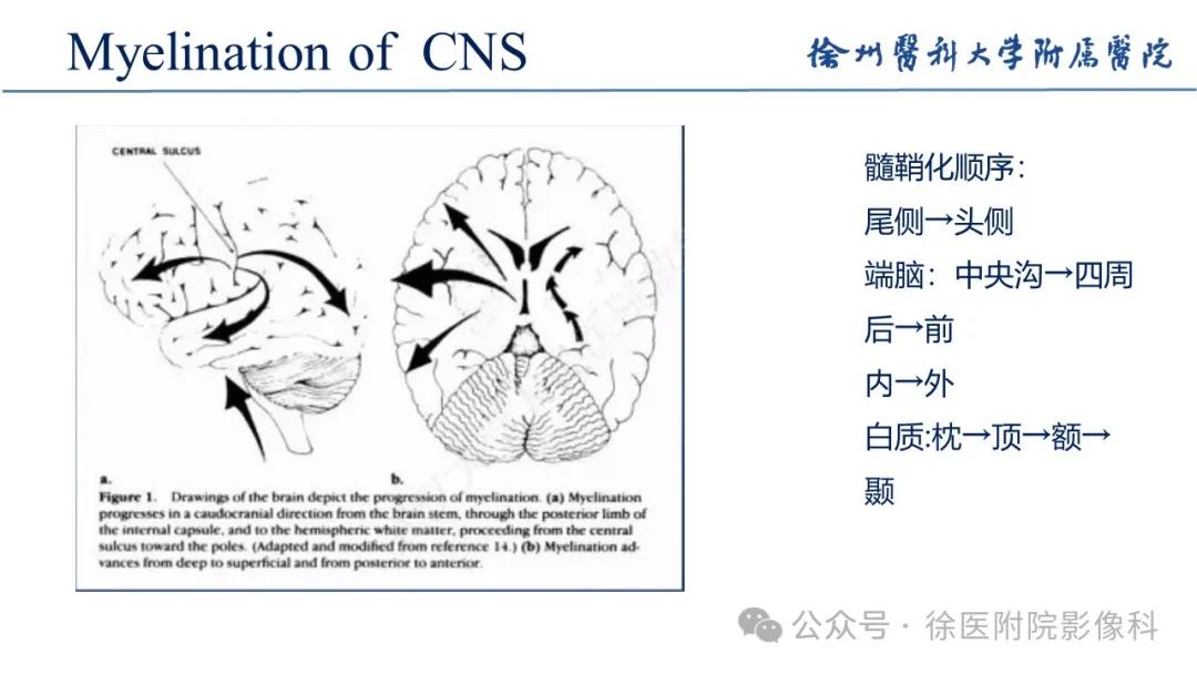 影像PPT - 【PPT】新生儿缺氧缺血性脑病-6