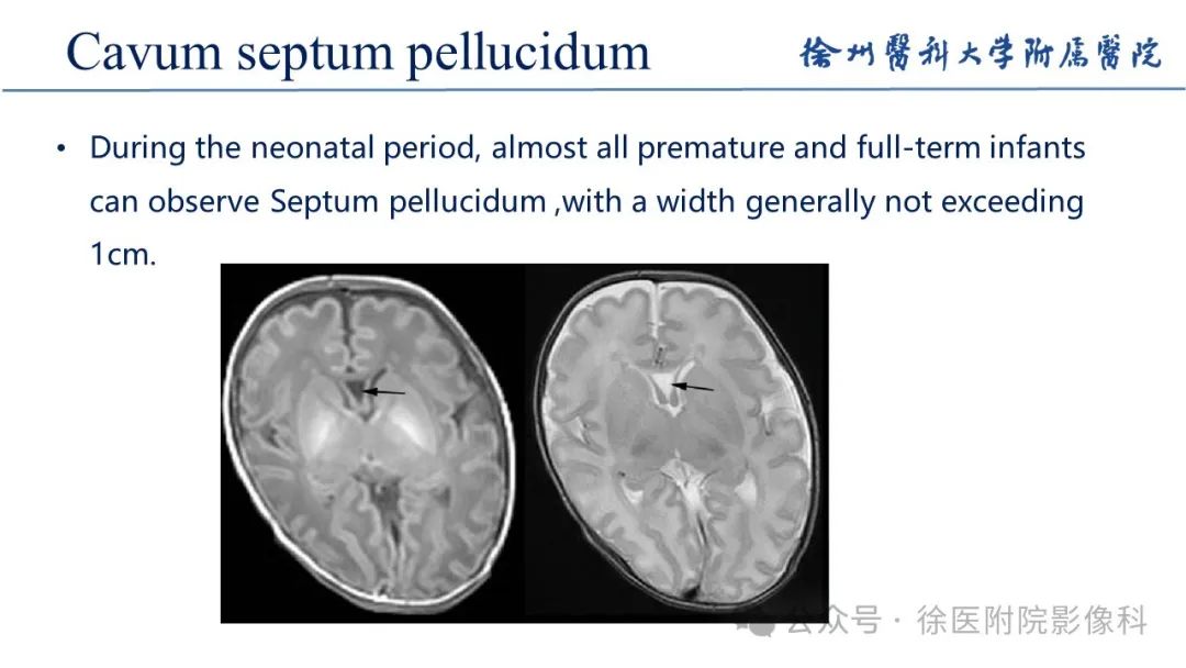 影像PPT - 【PPT】新生儿缺氧缺血性脑病-8