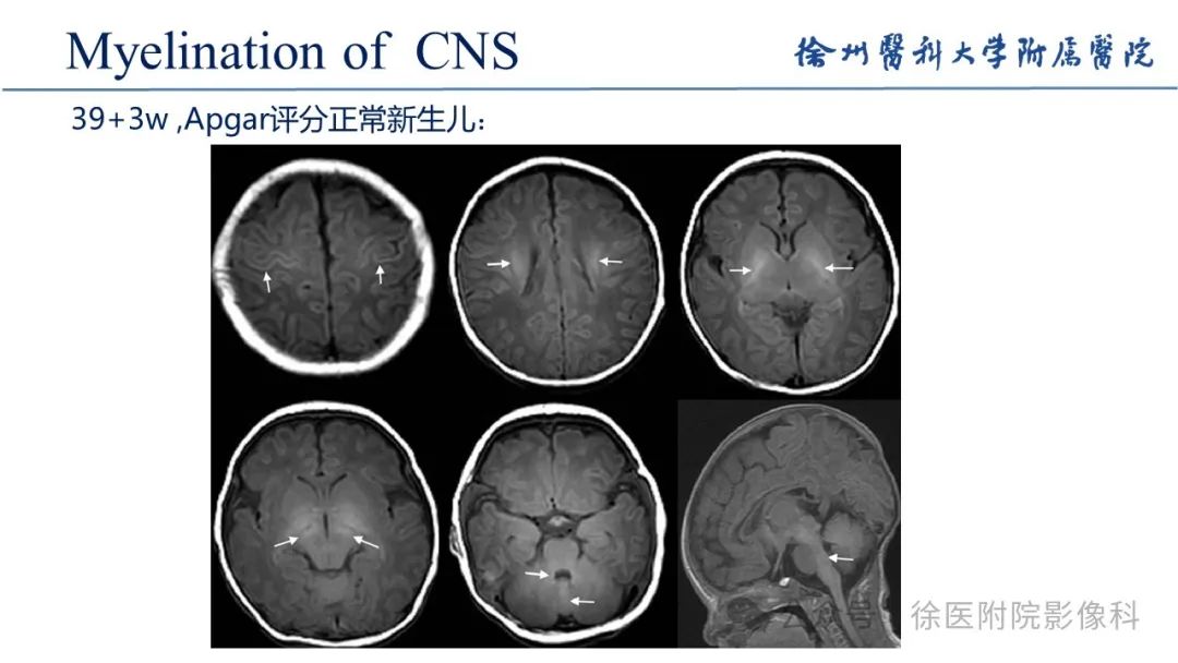 影像PPT - 【PPT】新生儿缺氧缺血性脑病-7
