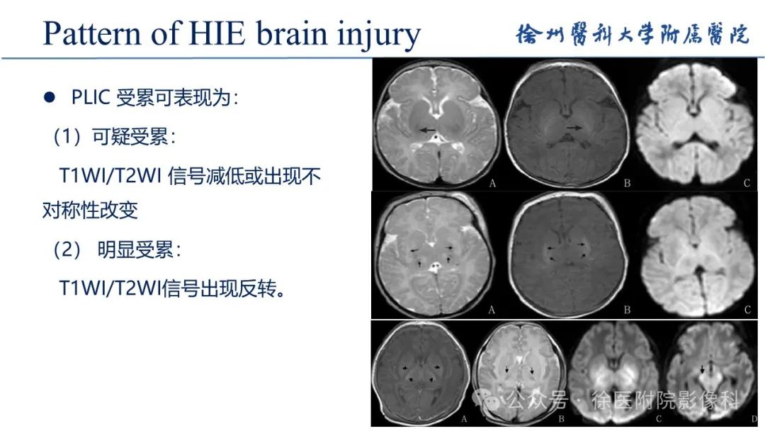 影像PPT - 【PPT】新生儿缺氧缺血性脑病-13