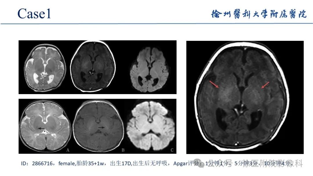 影像PPT - 【PPT】新生儿缺氧缺血性脑病-14