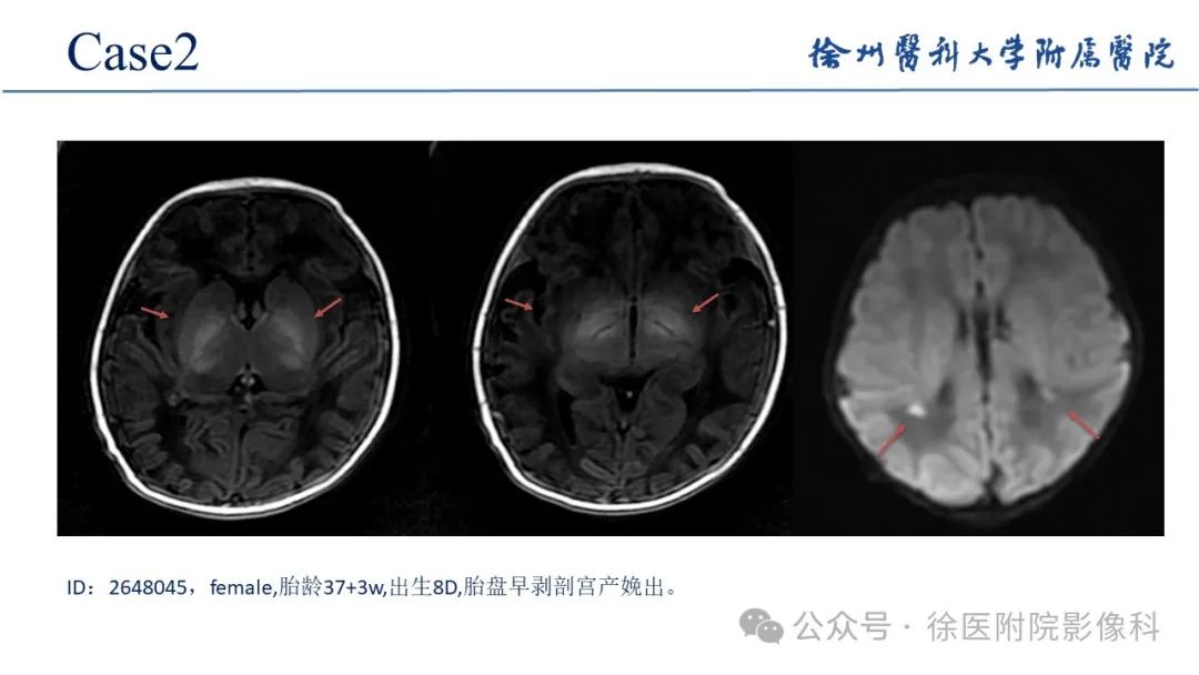 影像PPT - 【PPT】新生儿缺氧缺血性脑病-15